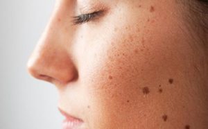 3 vùng da trên mặt có nguy cơ ung thư cao thường bị bỏ qua khi bôi kem chống nắng