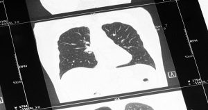 Ảnh hưởng của bệnh Lupus ban đỏ hệ thống đến phổi